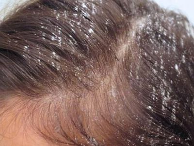 Home Remedies for Oily Scalp